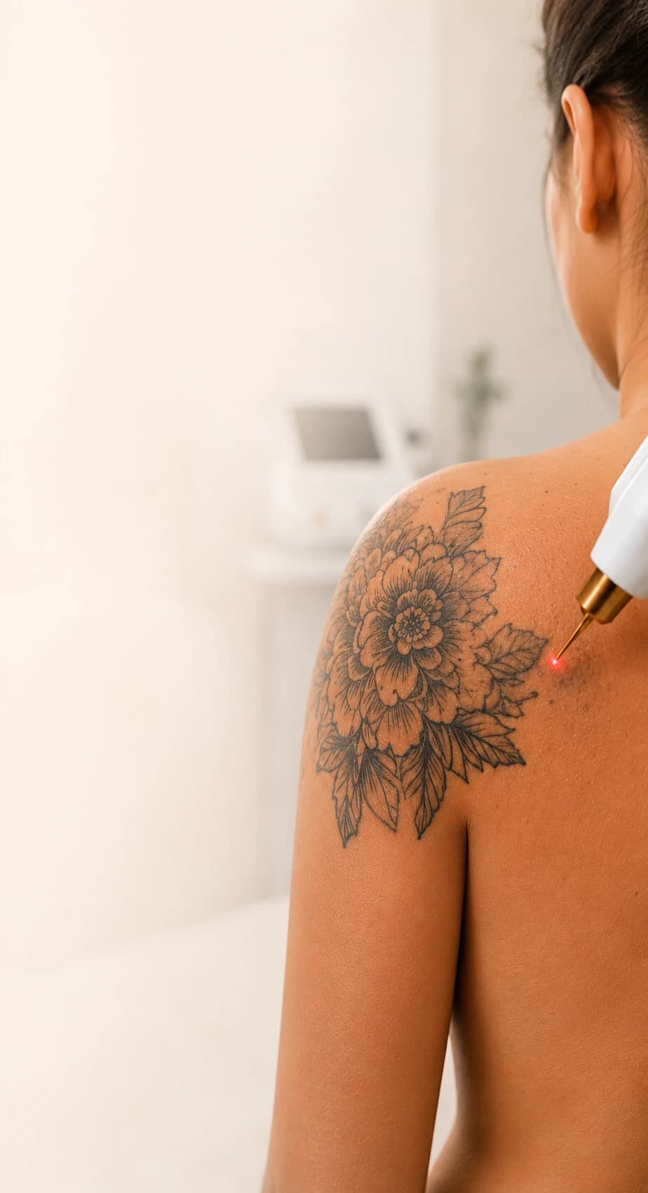 Illustrative photograph of a laser tattoo removal treatment